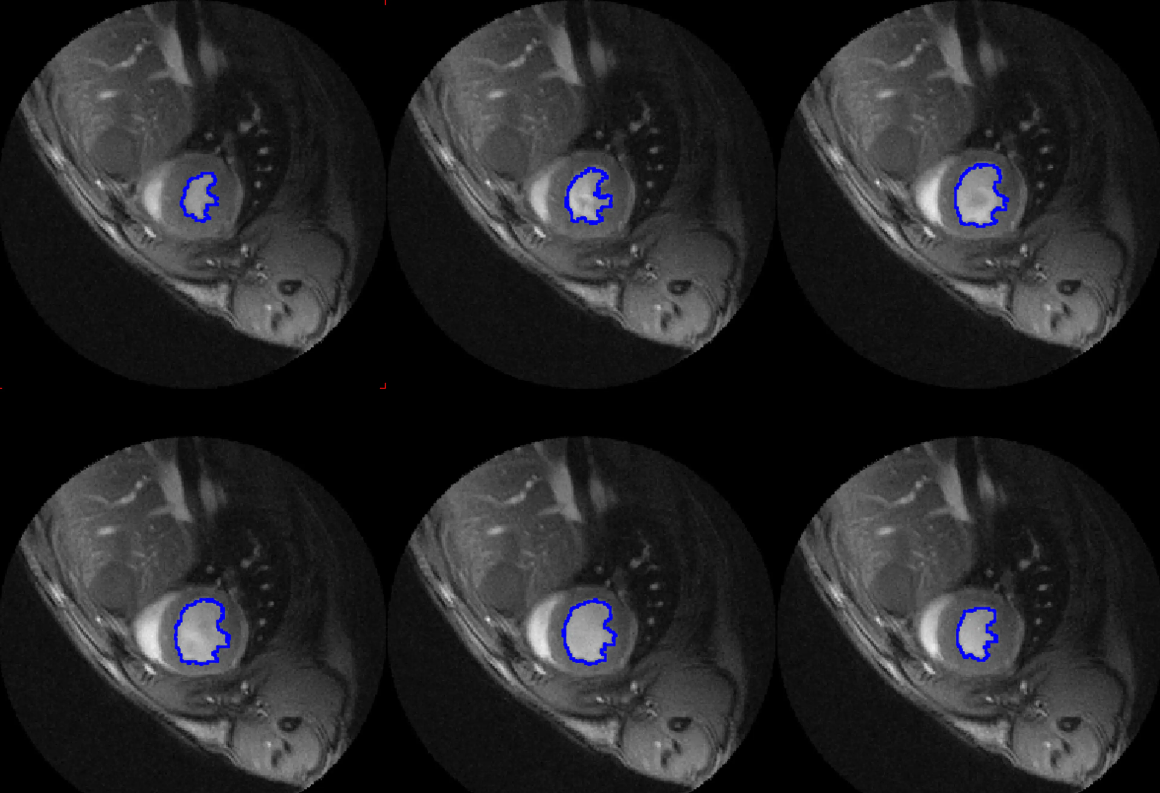 PCARDM Cardiac MR Analysis (Remote)